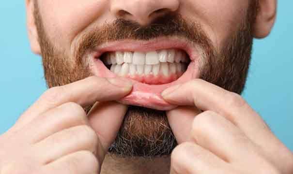 a man showing signs of gum disease