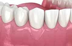 a 3D illustration of gum grafting