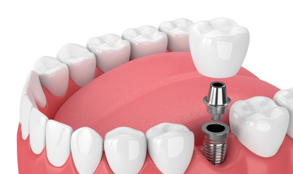 3D graphic of dental implant in mouth 