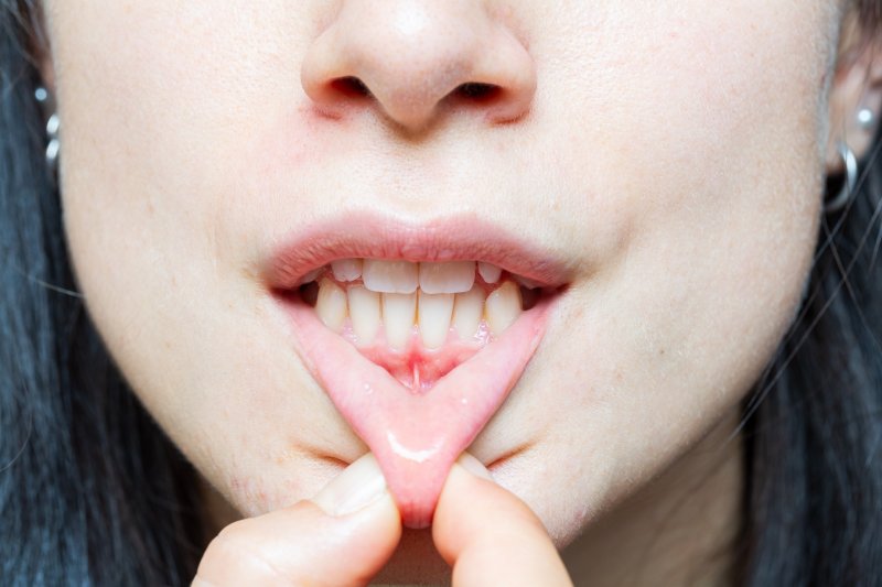 A closeup of a woman with receding gums